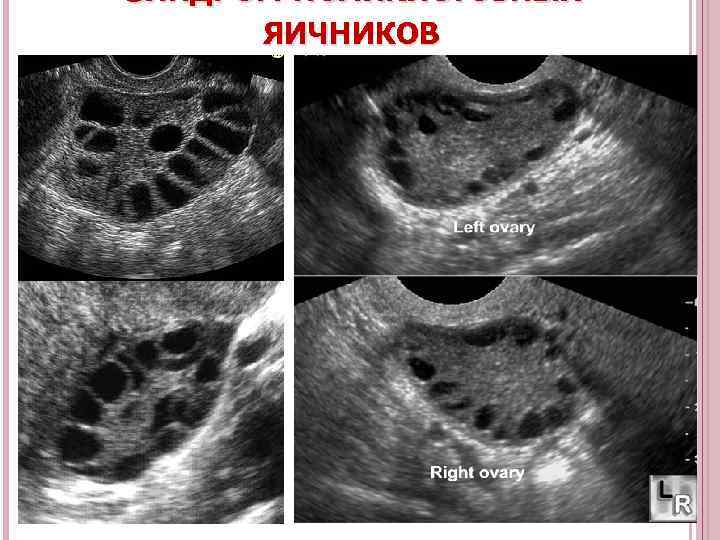 СИНДРОМ ПОЛИКИСТОЗНЫХ ЯИЧНИКОВ 