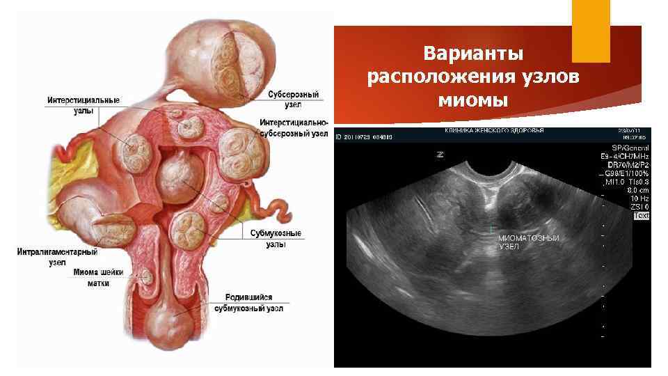 Варианты расположения узлов миомы 