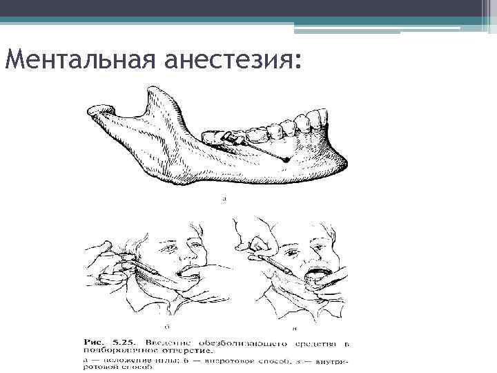 Ментальная анестезия презентация