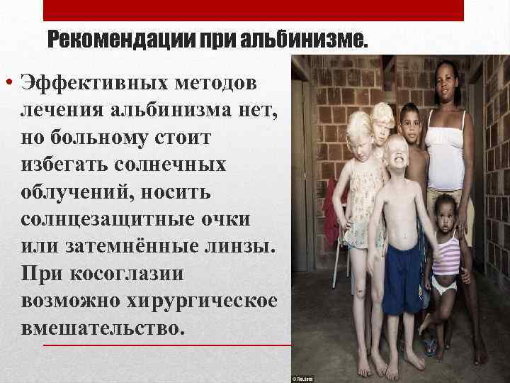 Рекомендации при альбинизме. • Эффективных методов лечения альбинизма нет, но больному стоит избегать солнечных