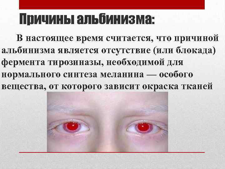 Причины альбинизма: В настоящее время считается, что причиной альбинизма является отсутствие (или блокада) фермента