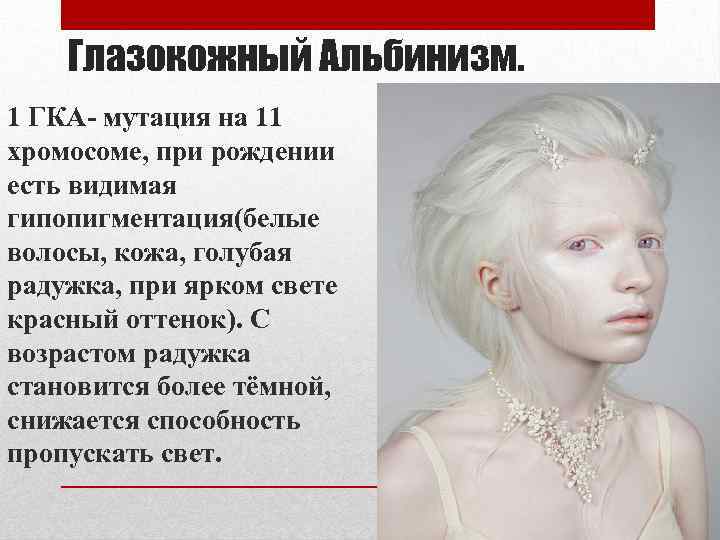 Глазокожный Альбинизм. 1 ГКА- мутация на 11 хромосоме, при рождении есть видимая гипопигментация(белые волосы,