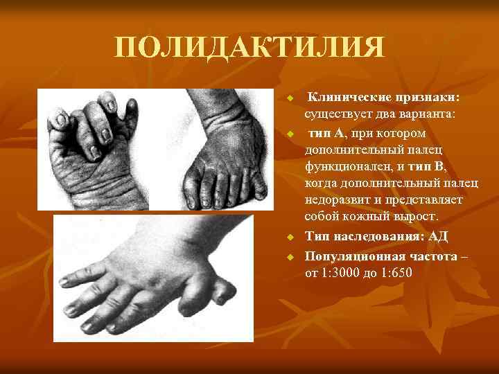 ПОЛИДАКТИЛИЯ u u Клинические признаки: существует два варианта: тип А, при котором дополнительный палец