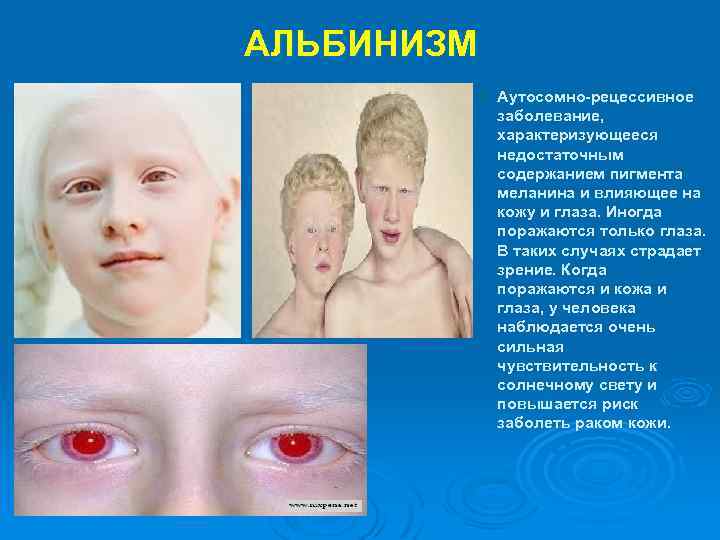 АЛЬБИНИЗМ v Аутосомно-рецессивное заболевание, характеризующееся недостаточным содержанием пигмента меланина и влияющее на кожу и