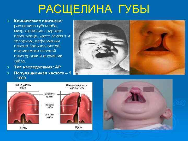 РАСЩЕЛИНА ГУБЫ Клинические признаки: расщелина губы/неба, микроцефалия, широкая переносица, часто эпикант и телоризм, деформации