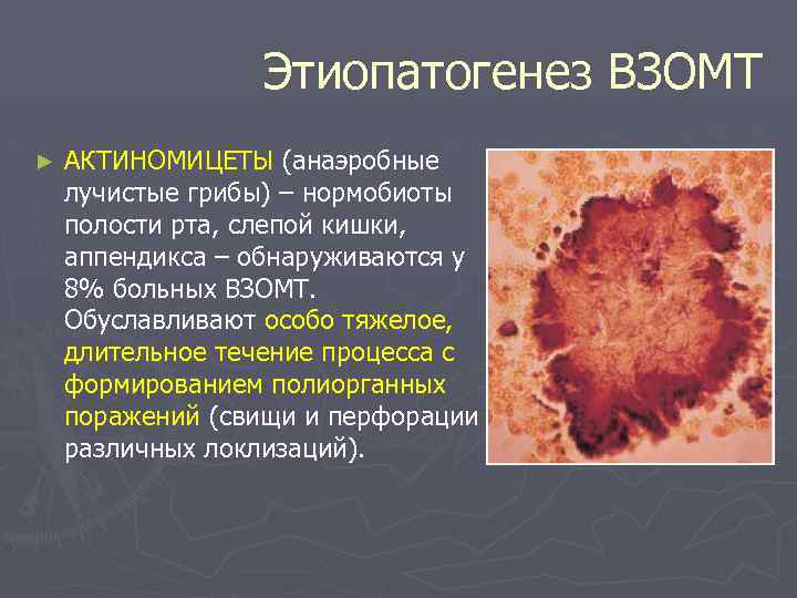 Этиопатогенез ВЗОМТ ► АКТИНОМИЦЕТЫ (анаэробные лучистые грибы) – нормобиоты полости рта, слепой кишки, аппендикса