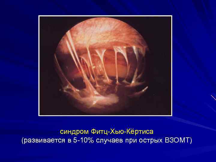 синдром Фитц-Хью-Кёртиса (развивается в 5 -10% случаев при острых ВЗОМТ) 