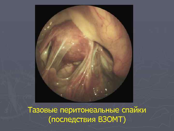 Тазовые перитонеальные спайки (последствия ВЗОМТ) 