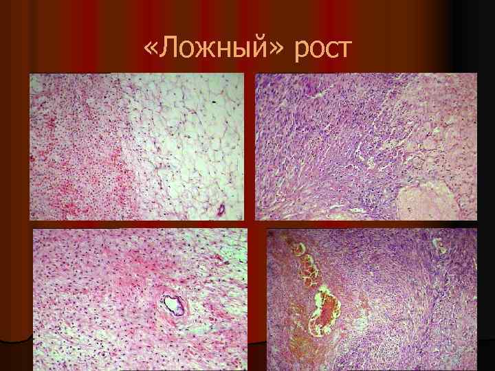  «Ложный» рост 