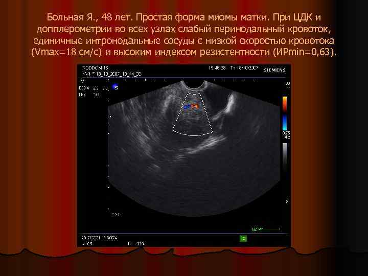 Больная Я. , 48 лет. Простая форма миомы матки. При ЦДК и допплерометрии во