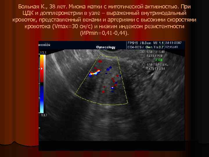 Больная К. , 38 лет. Миома матки с митотической активностью. При ЦДК и допплерометрии