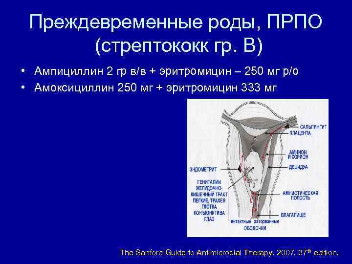 Преждевременные роды, ПРПО (стрептококк гр. В) • Ампициллин 2 гр в/в + эритромицин –