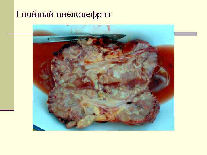 Гнойный пиелонефрит 