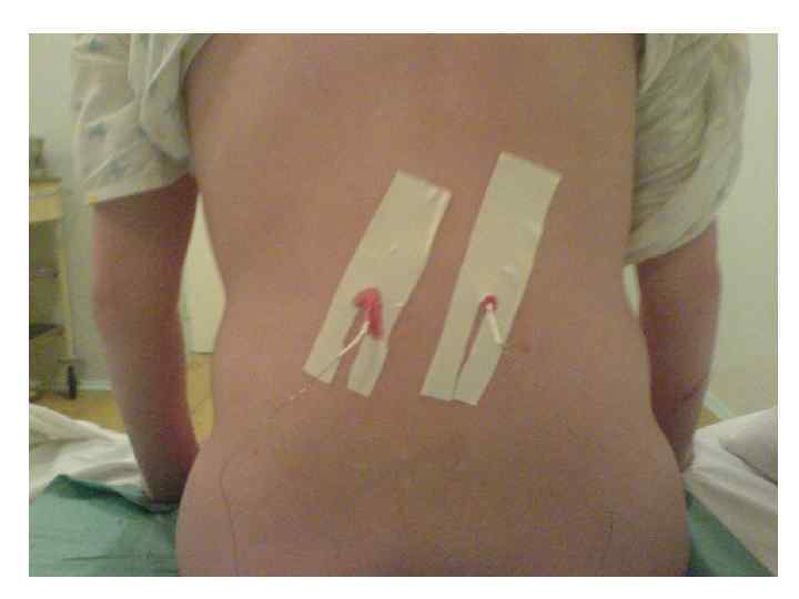 МЕТОДИКА На расстоянии 1, 5 – 2 см. от остистого отростка L 1 перпендикулярно