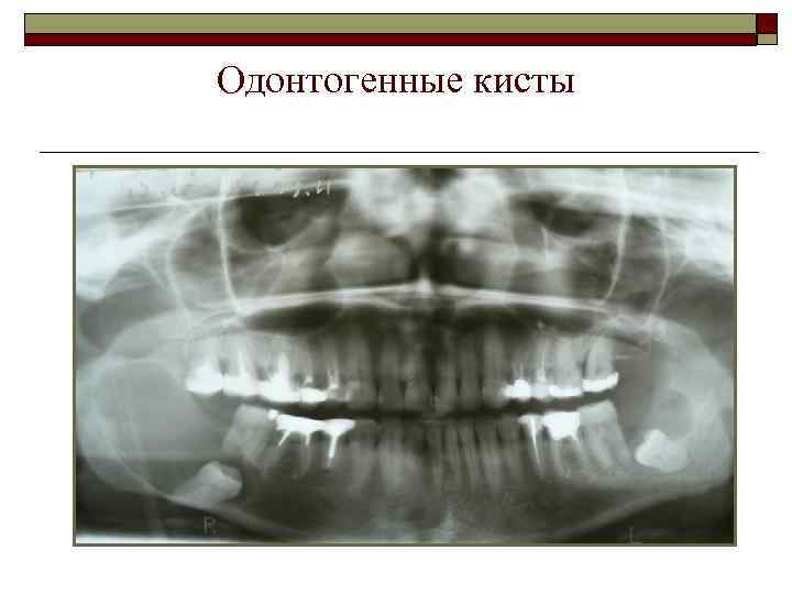 Одонтогенные кисты 