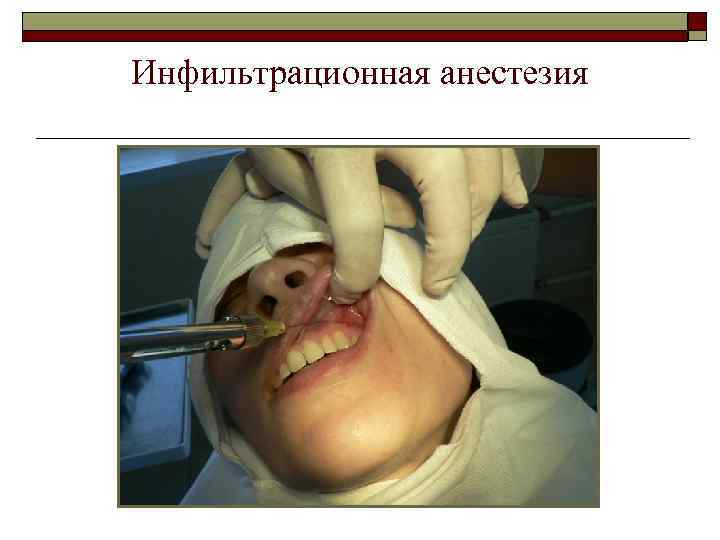 Инфильтрационная анестезия 
