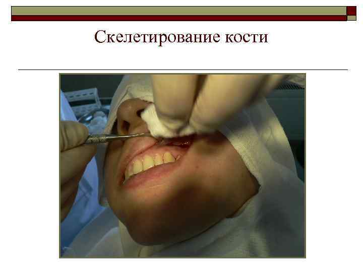 Скелетирование кости 