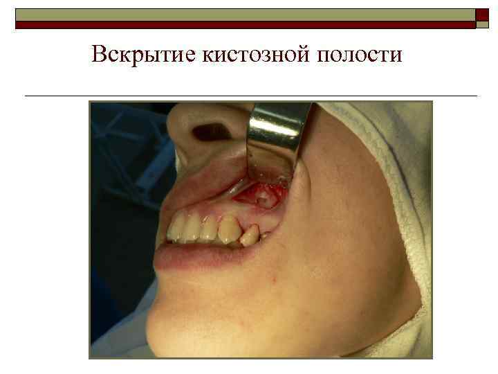 Вскрытие кистозной полости 