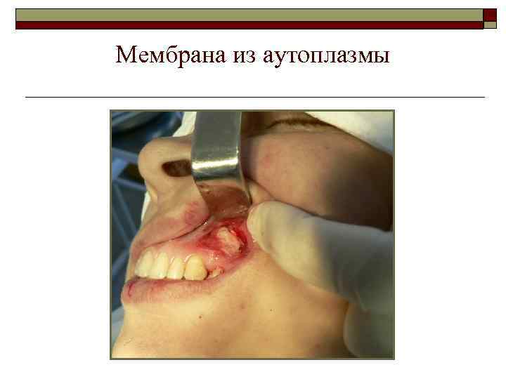 Мембрана из аутоплазмы 