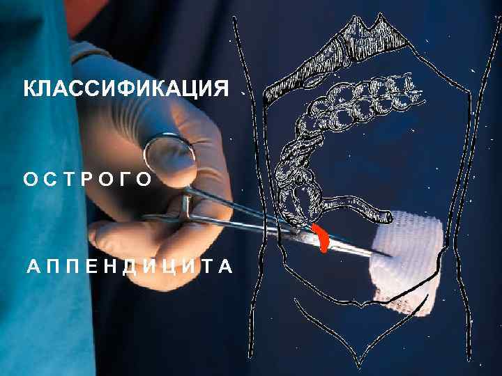 КЛАССИФИКАЦИЯ ОСТРОГО АППЕНДИЦИТА 