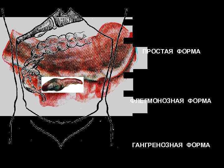 ПРОСТАЯ ФОРМА ФЛЕГМОНОЗНАЯ ФОРМА ГАНГРЕНОЗНАЯ ФОРМА 