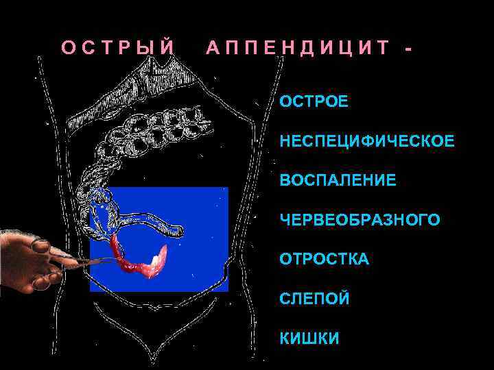 ОСТРЫЙ АППЕНДИЦИТ ОСТРОЕ НЕСПЕЦИФИЧЕСКОЕ ВОСПАЛЕНИЕ ЧЕРВЕОБРАЗНОГО ОТРОСТКА СЛЕПОЙ КИШКИ 