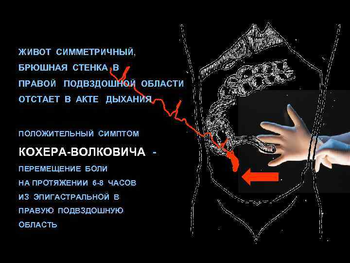 ЖИВОТ СИММЕТРИЧНЫЙ, БРЮШНАЯ СТЕНКА В ПРАВОЙ ПОДВЗДОШНОЙ ОБЛАСТИ ОТСТАЕТ В АКТЕ ДЫХАНИЯ ПОЛОЖИТЕЛЬНЫЙ СИМПТОМ