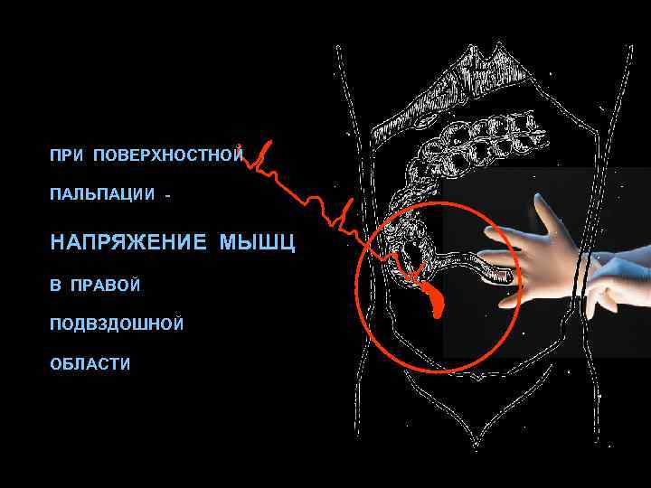 ПРИ ПОВЕРХНОСТНОЙ ПАЛЬПАЦИИ - НАПРЯЖЕНИЕ МЫШЦ В ПРАВОЙ ПОДВЗДОШНОЙ ОБЛАСТИ 