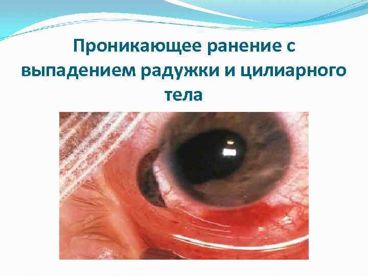 Проникающее ранение с выпадением радужки и цилиарного тела 