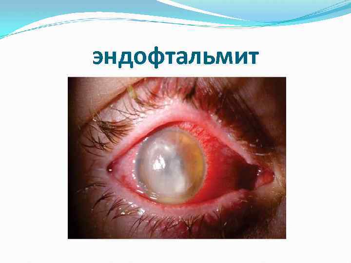 эндофтальмит 