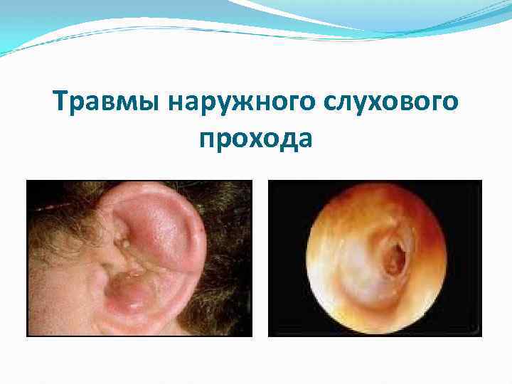 Травмы наружного слухового прохода 