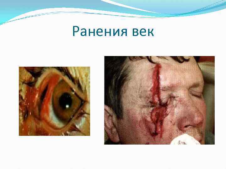 Ранения век 