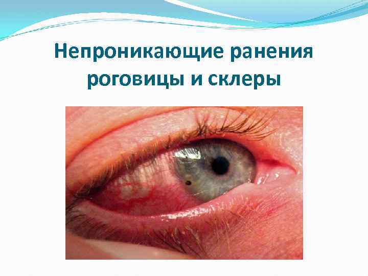 Непроникающие ранения роговицы и склеры 