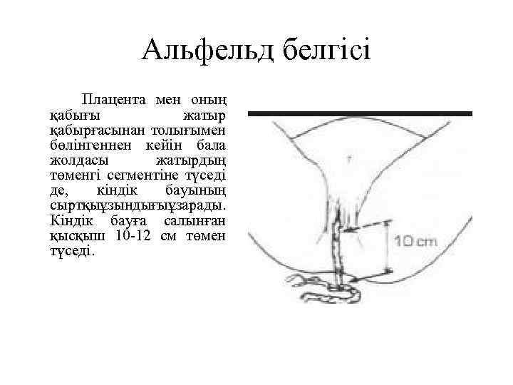 Альфельд белгісі Плацента мен оның қабығы жатыр қабырғасынан толығымен бөлінгеннен кейін бала жолдасы жатырдың