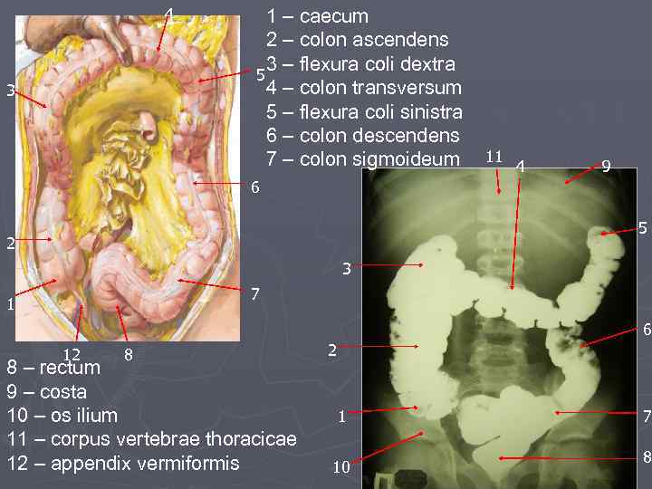 4 3 1 – caecum 2 – colon ascendens 3 – flexura coli dextra