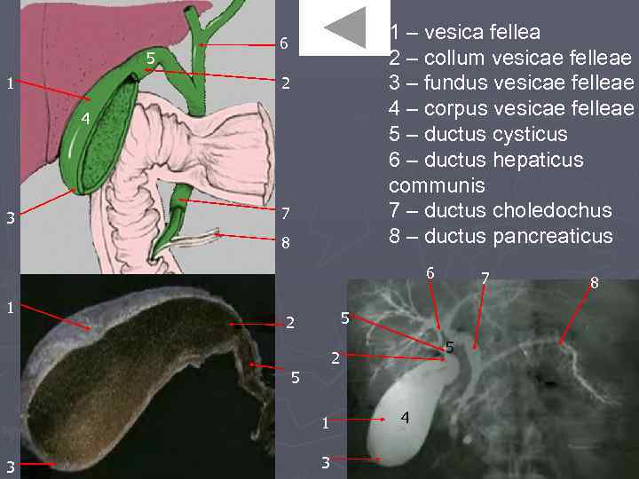 5 1 1 – vesica fellea 2 – collum vesicae felleae 3 – fundus