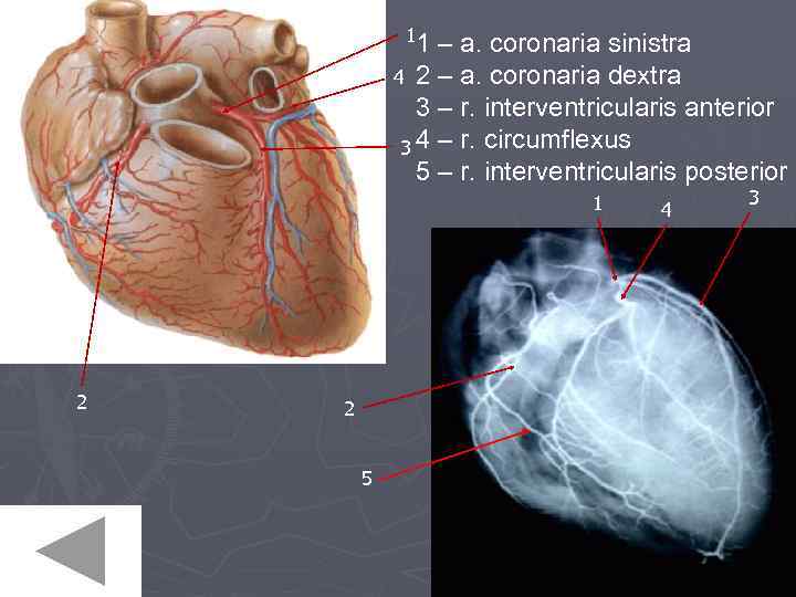 1 1 – a. coronaria sinistra 4 2 – a. coronaria dextra 3 –