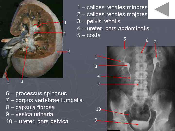 1 – calices renales minores 2 – calices renales majores 3 – pelvis renalis