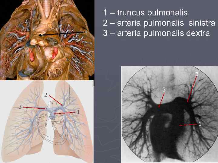 1 1 – truncus pulmonalis 2 – arteria pulmonalis sinistra 3 – arteria pulmonalis