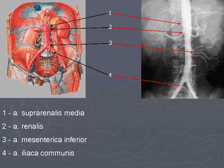 1 2 3 4 1 - a. suprarenalis media 2 - a. renalis 3