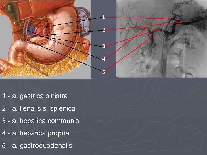 1 2 3 4 5 1 - a. gastrica sinistra 2 - a. lienalis