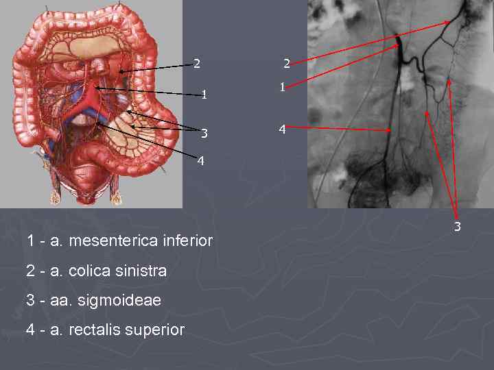 2 2 1 3 1 4 4 1 - a. mesenterica inferior 2 -