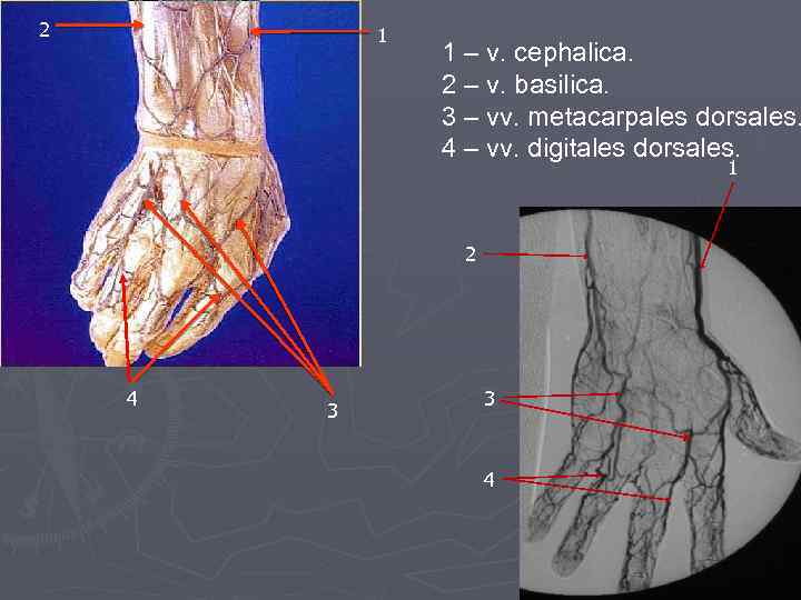 2 1 1 – v. cephalica. 2 – v. basilica. 3 – vv. metacarpales