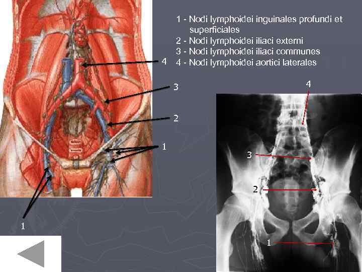 4 1 - Nodi lymphoidei inguinales profundi et superficiales 2 - Nodi lymphoidei iliaci