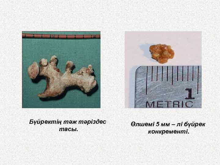 Бүйректің тәж тәріздес тасы. Өлшемі 5 мм – лі бүйрек конкременті. 