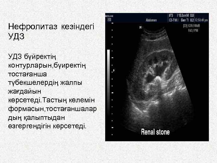 Нефролитаз кезіндегі УДЗ бүйректің контурларын, бүиректің тостағанша түбекшелердің жалпы жағдайын көрсетеді. Тастың көлемін формасын,