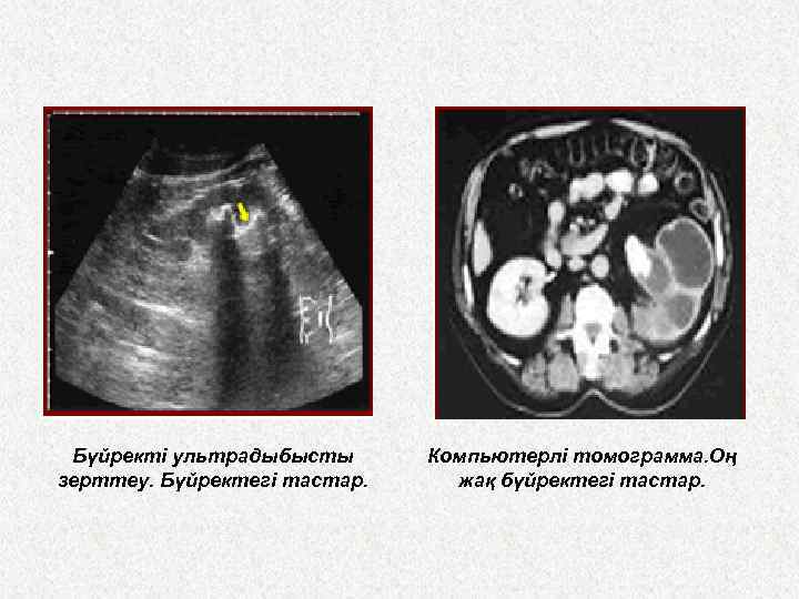 Бүйректі ультрадыбысты зерттеу. Бүйректегі тастар. Компьютерлі томограмма. Оң жақ бүйректегі тастар. 