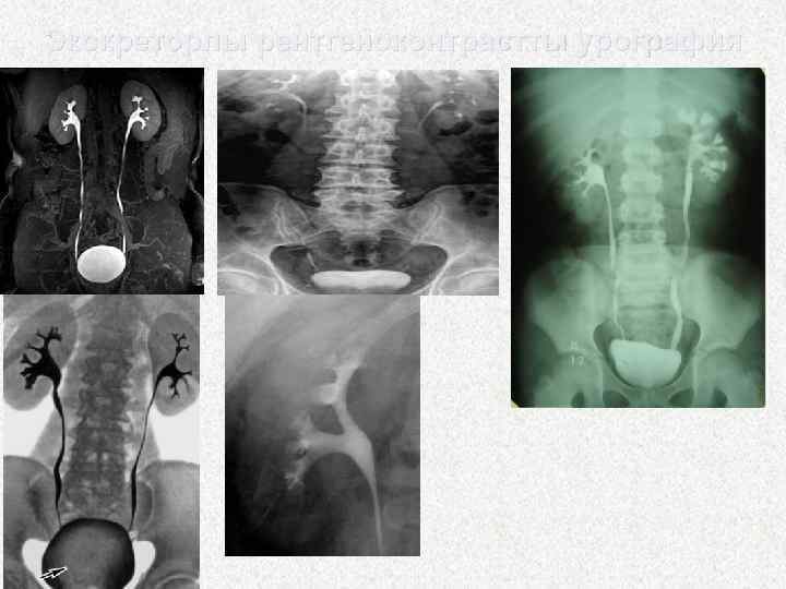 Экскреторлы рентгеноконтрастты урография 
