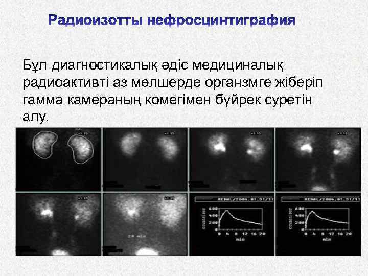 Бұл диагностикалық әдіс медициналық радиоактивті аз мөлшерде органзмге жіберіп гамма камераның комегімен бүйрек суретін