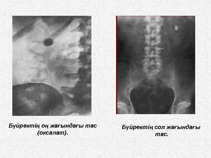 Бүйректің оң жағындағы тас (оксалат). Бүйректің сол жағындағы тас. 